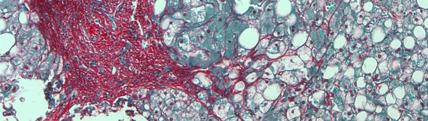 Sirius Red staining showing red collagen fibrils in a liver section from mice with Fatty Liver Disease