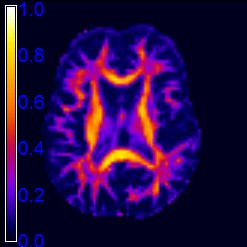 FA - Fractional anisotropy, degree of anisotropy of the diffusion tensor74