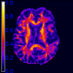 KFA - Kurtosis fractional anisotropy, degree of anisotropy of the kurtosis tensor75