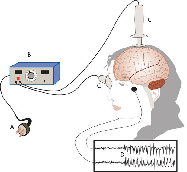 Electroconvulsive Therapy (ECT) | College Of Medicine | MUSC