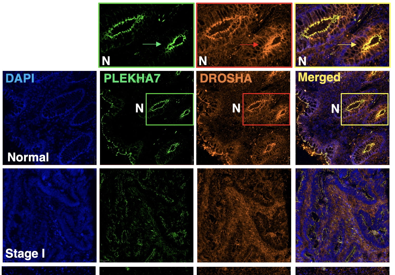 Immunostaining in colon cancer tissue