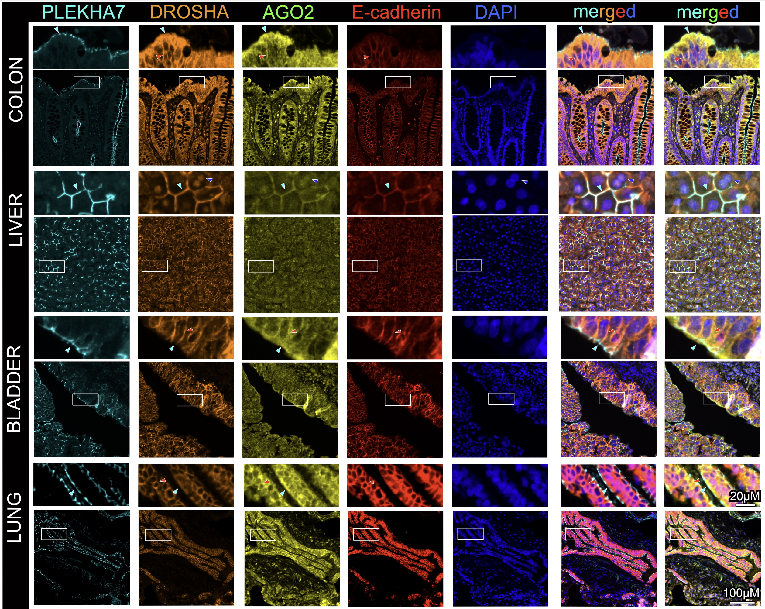 Immunostaining in colon cancer tissue