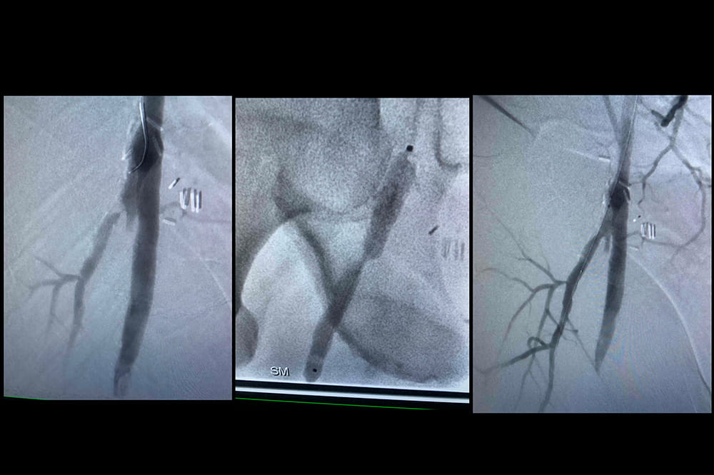  a series of three images of an artery with blocked blood flow before, during and after intervention