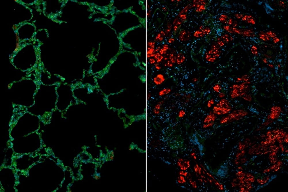 Immunofluorescence images showing healthy (left) and scleroderma  (right) lung. The scleroderma  lung shows reduced levels of Cathepsin L (green) and increased levels of fibroblast activation marker.