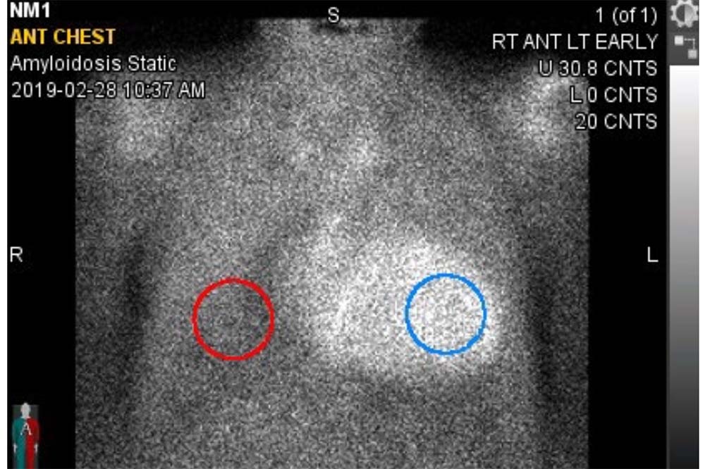 Black and white picture of a torso. The right side is lit up and there are red and blue circles drawn over the image.