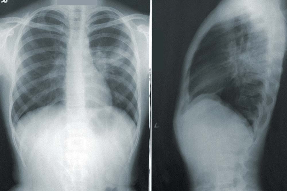 chest X-ray shows pneumonia in the lungs.